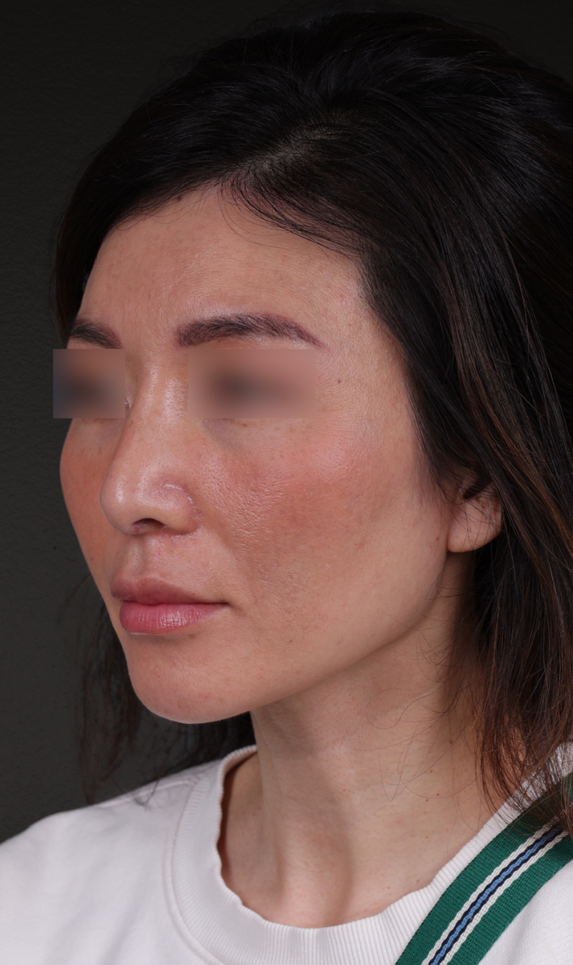 Fat Grafting Before & After Gallery - Patient 320694 - Image 8