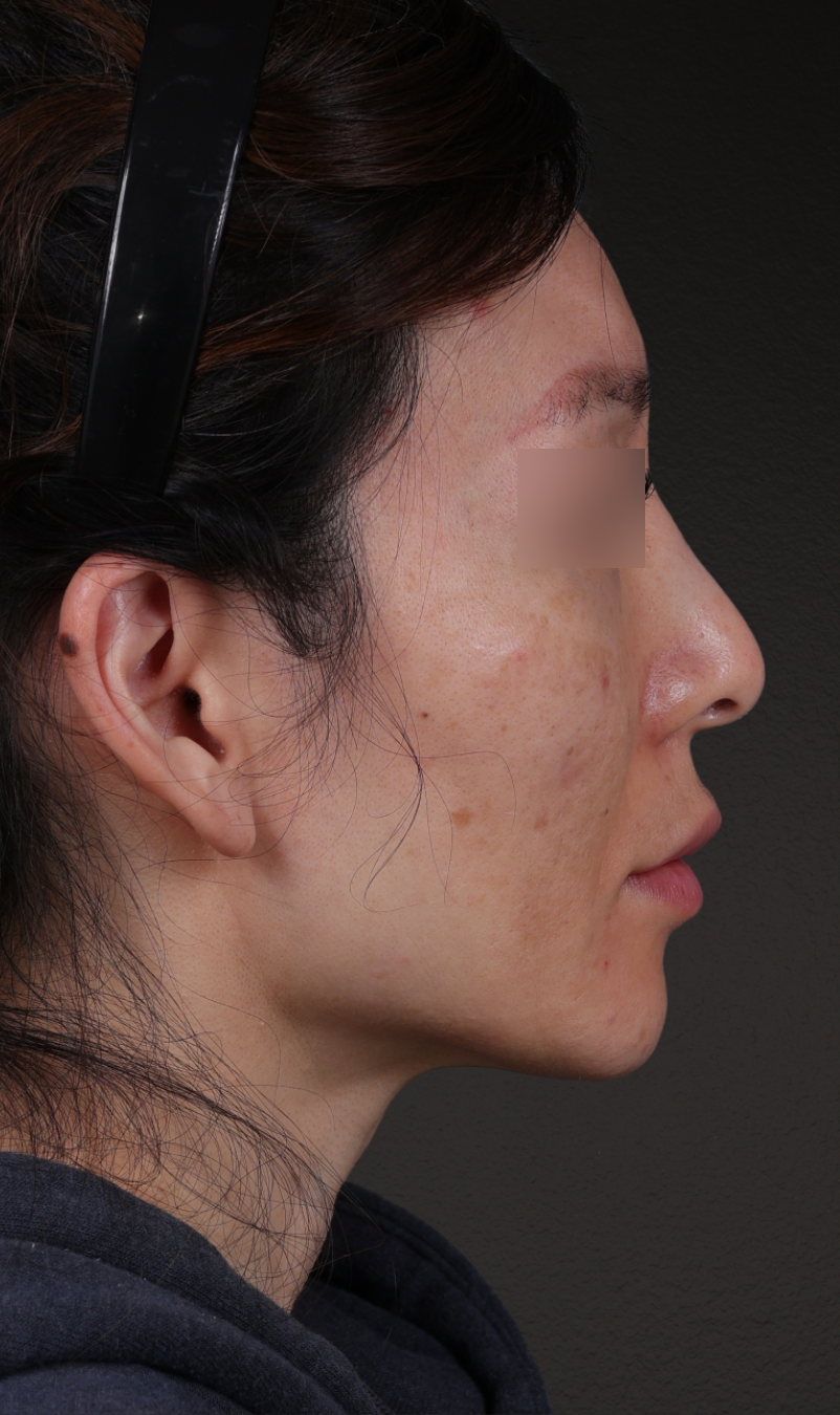 Fat Grafting Before & After Gallery - Patient 320694 - Image 5