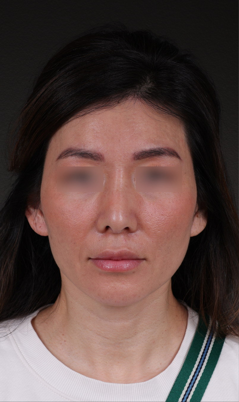 Fat Grafting Before & After Gallery - Patient 320694 - Image 2