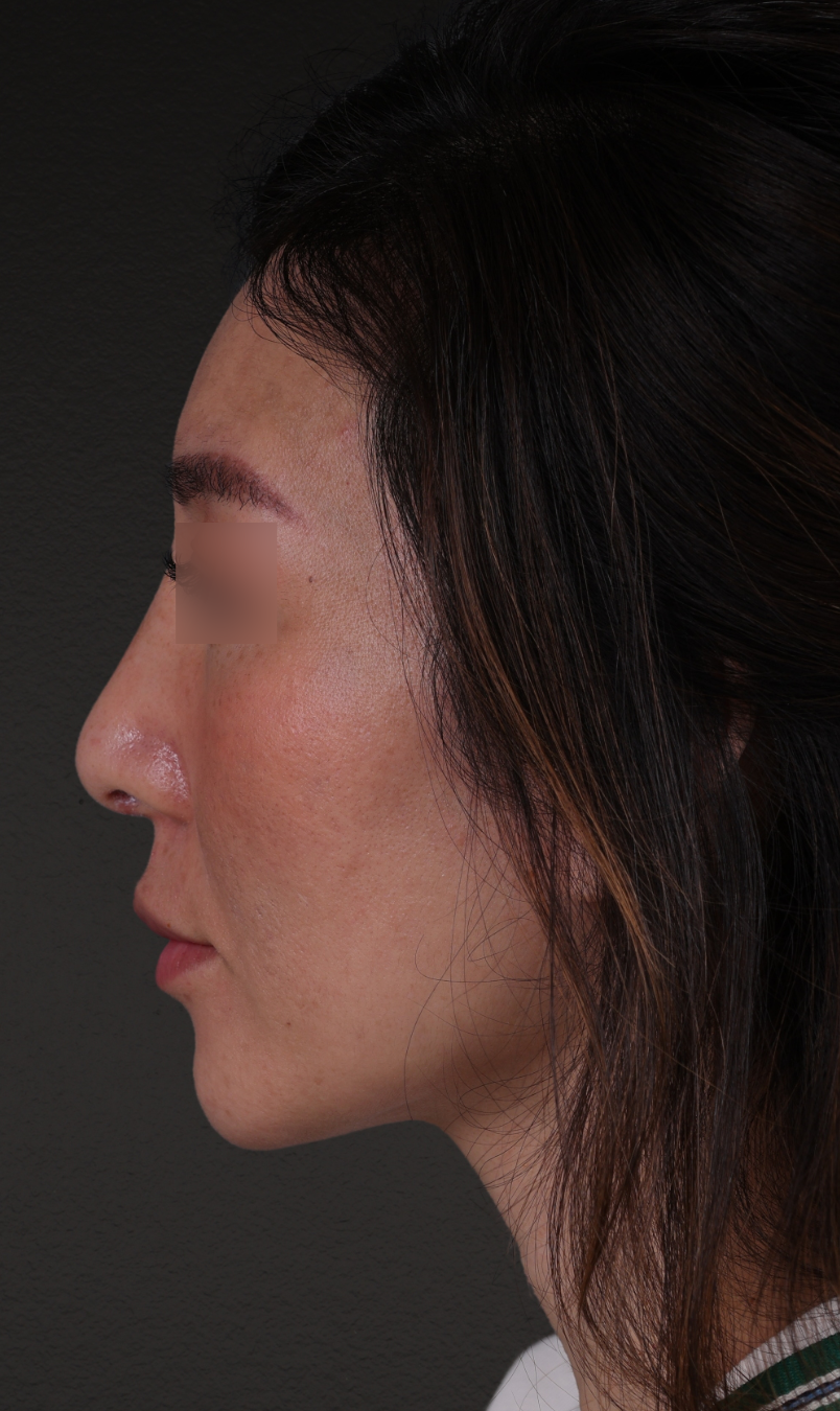 Fat Grafting Before & After Gallery - Patient 320694 - Image 10