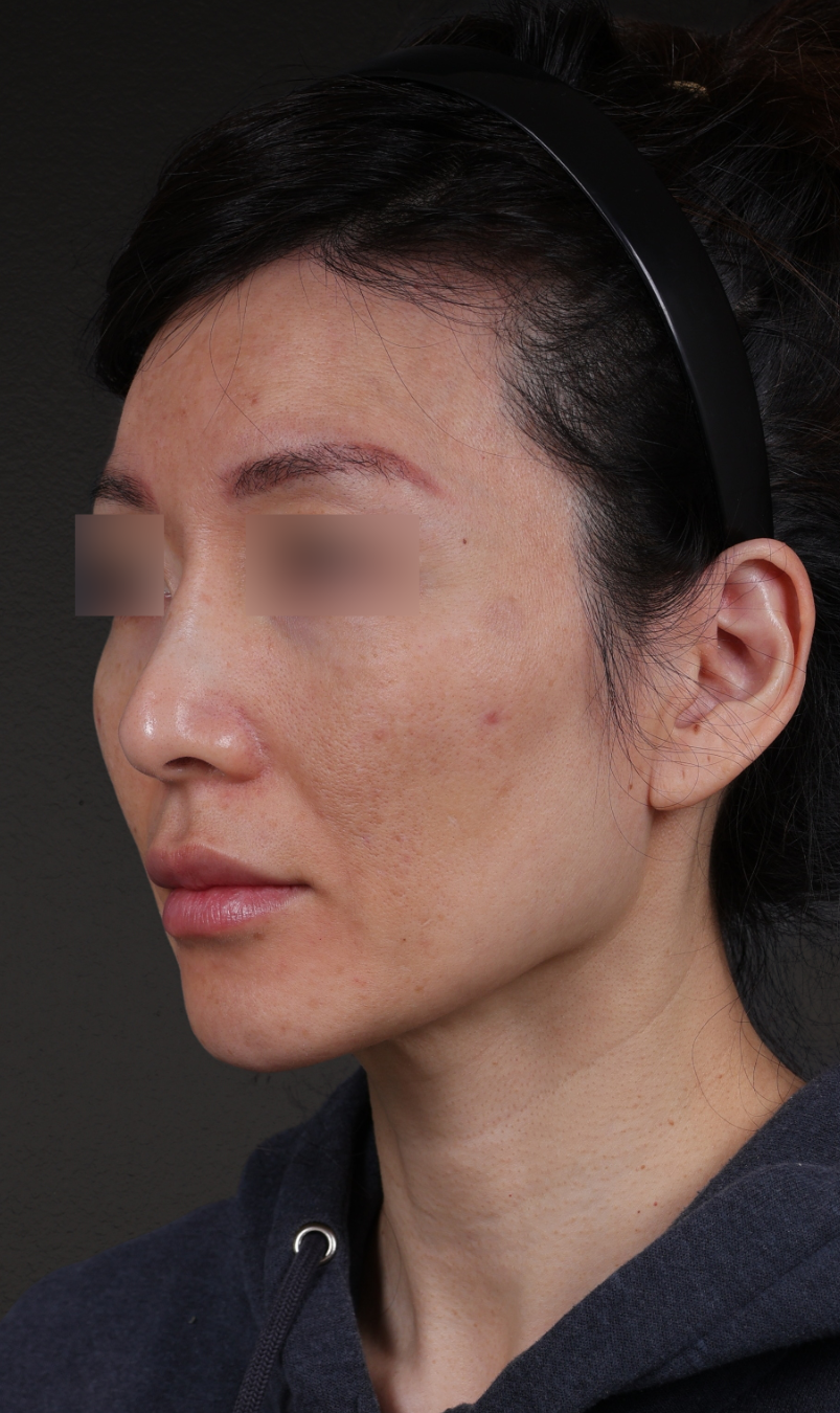 Fat Grafting Before & After Gallery - Patient 320694 - Image 7