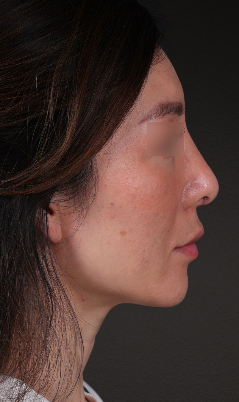 Fat Grafting Before & After Gallery - Patient 320694 - Image 6