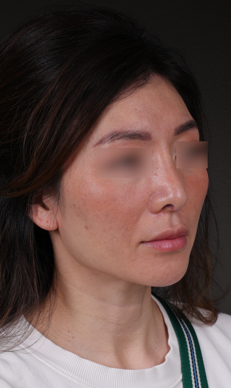 Fat Grafting Before & After Gallery - Patient 320694 - Image 4