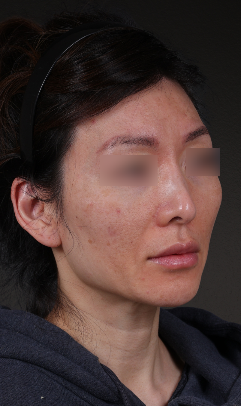 Fat Grafting Before & After Gallery - Patient 320694 - Image 3