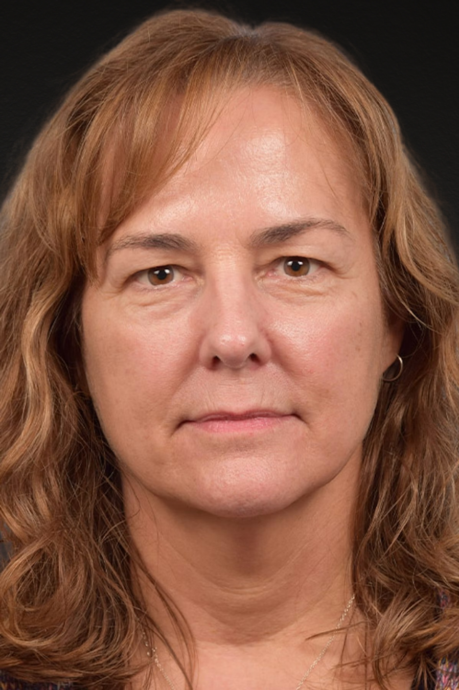 Botox and Dysport Before & After Gallery - Patient 426304 - Image 2