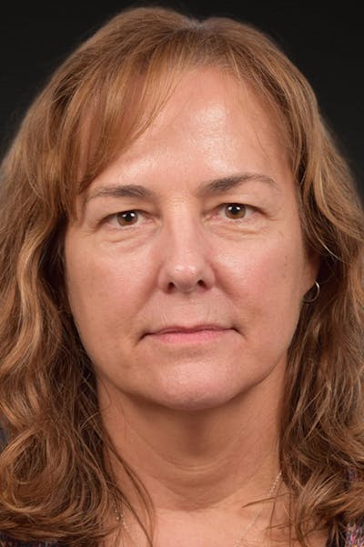 Botox and Dysport Before & After Gallery - Patient 426304 - Image 2