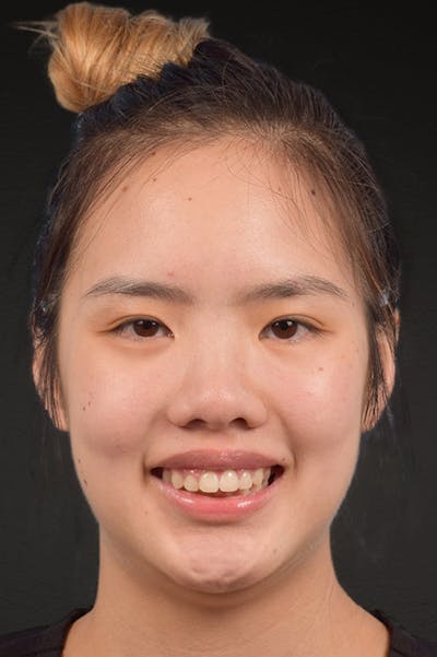 Botox and Dysport Before & After Gallery - Patient 161205 - Image 2