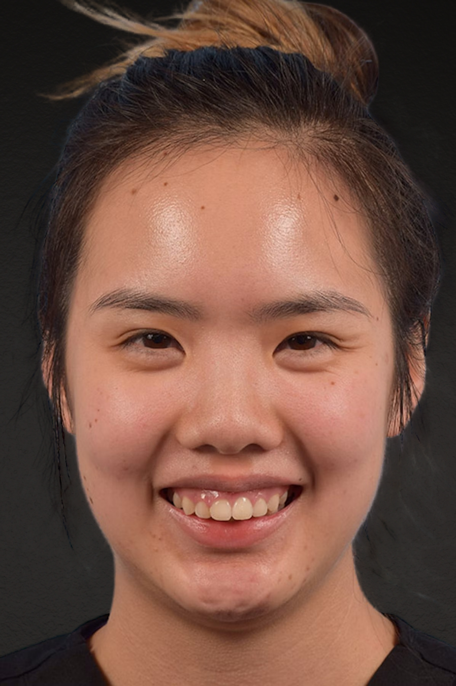 Botox and Dysport Before & After Gallery - Patient 161205 - Image 1
