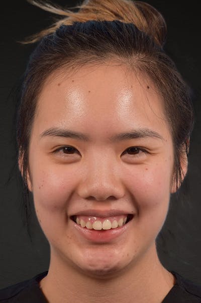 Botox and Dysport Before & After Gallery - Patient 161205 - Image 1