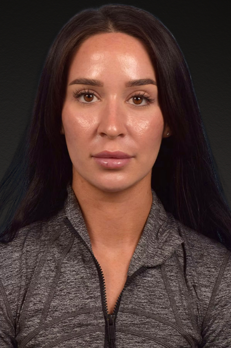 Botox and Dysport Before & After Gallery - Patient 144622 - Image 2