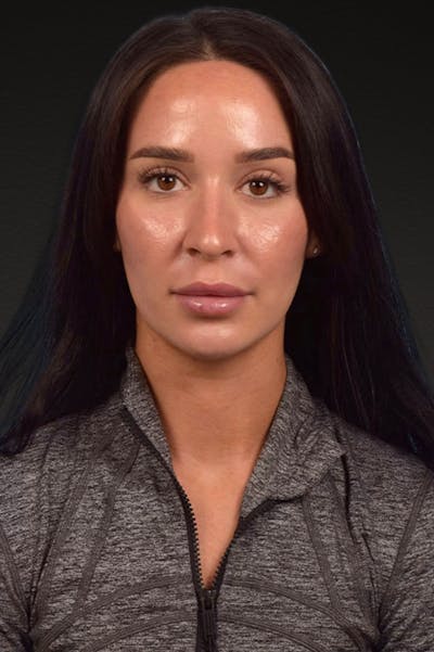 Botox and Dysport Before & After Gallery - Patient 144622 - Image 2