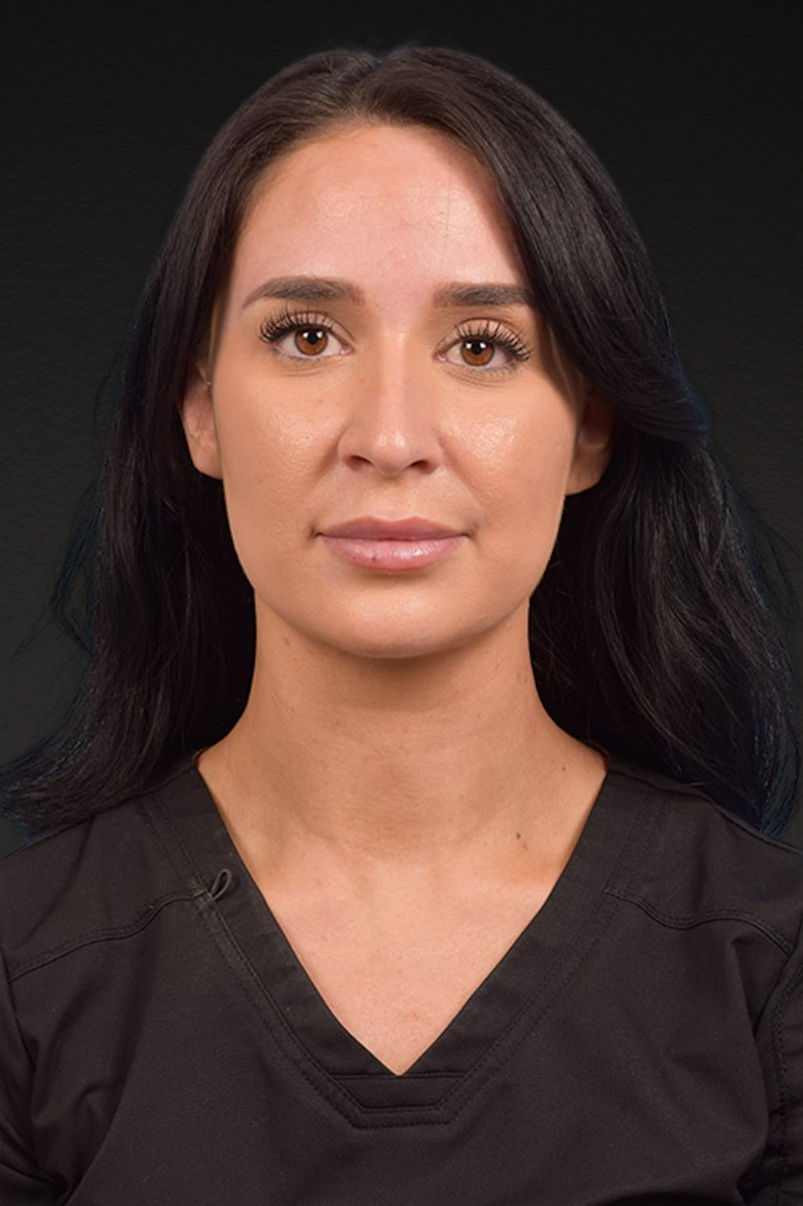 Botox and Dysport Before & After Gallery - Patient 144622 - Image 1