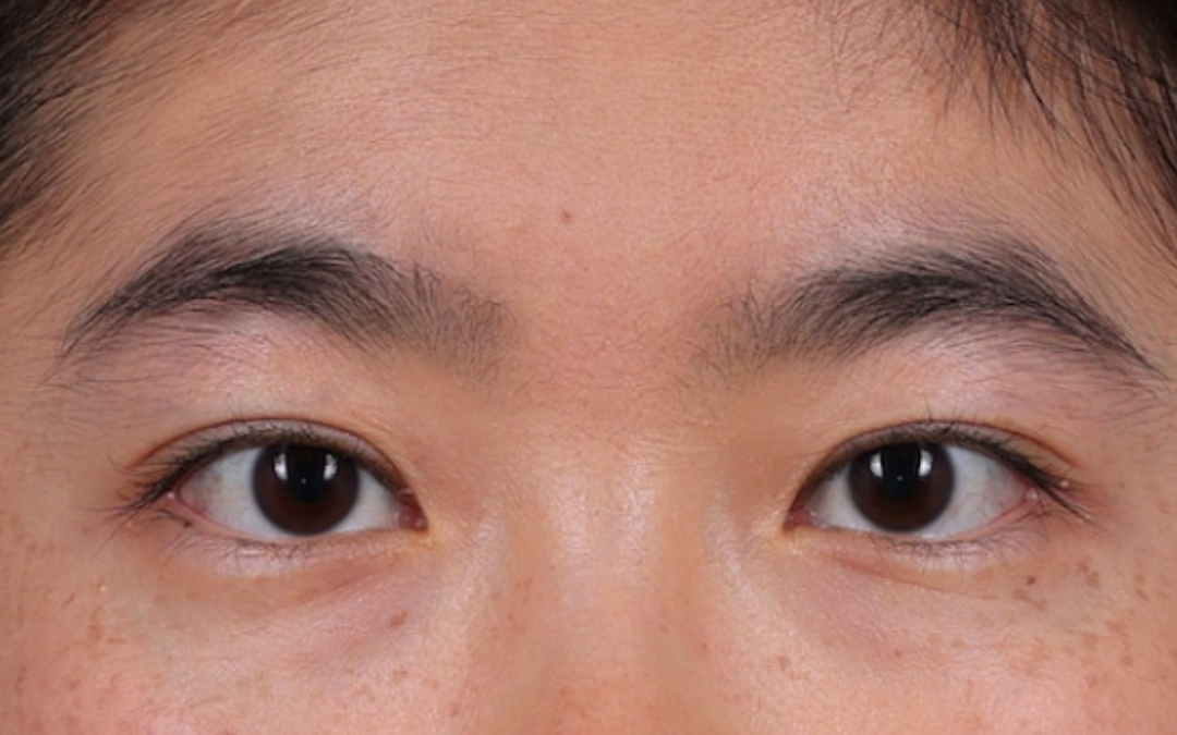 Blepharoplasty Before & After Gallery - Patient 288067 - Image 2