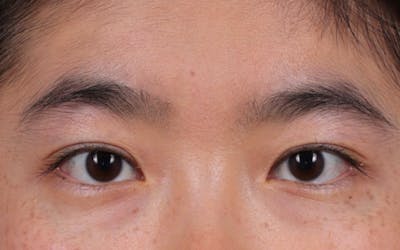 Blepharoplasty Before & After Gallery - Patient 288067 - Image 2