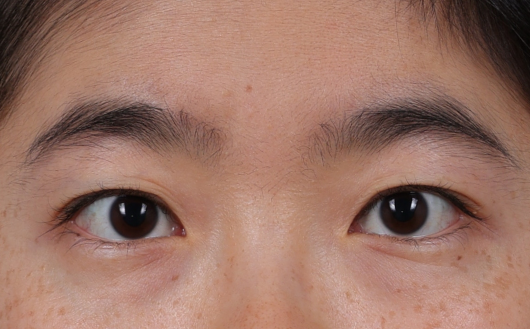 Blepharoplasty Before & After Gallery - Patient 288067 - Image 1