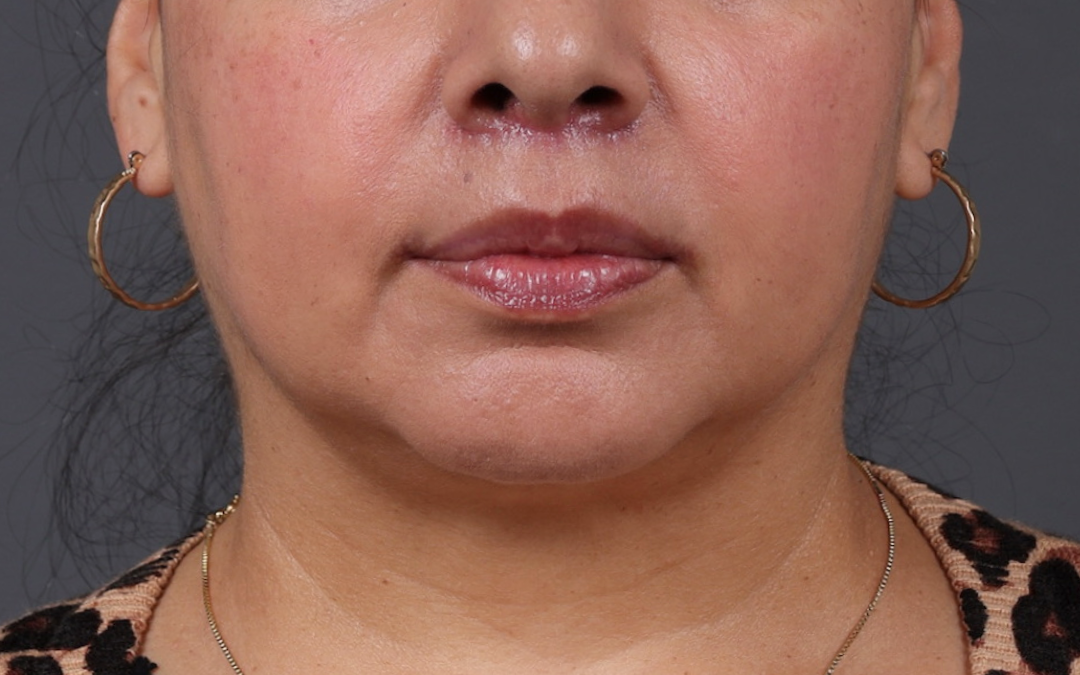 Lip Lift Before & After Gallery - Patient 209400 - Image 2