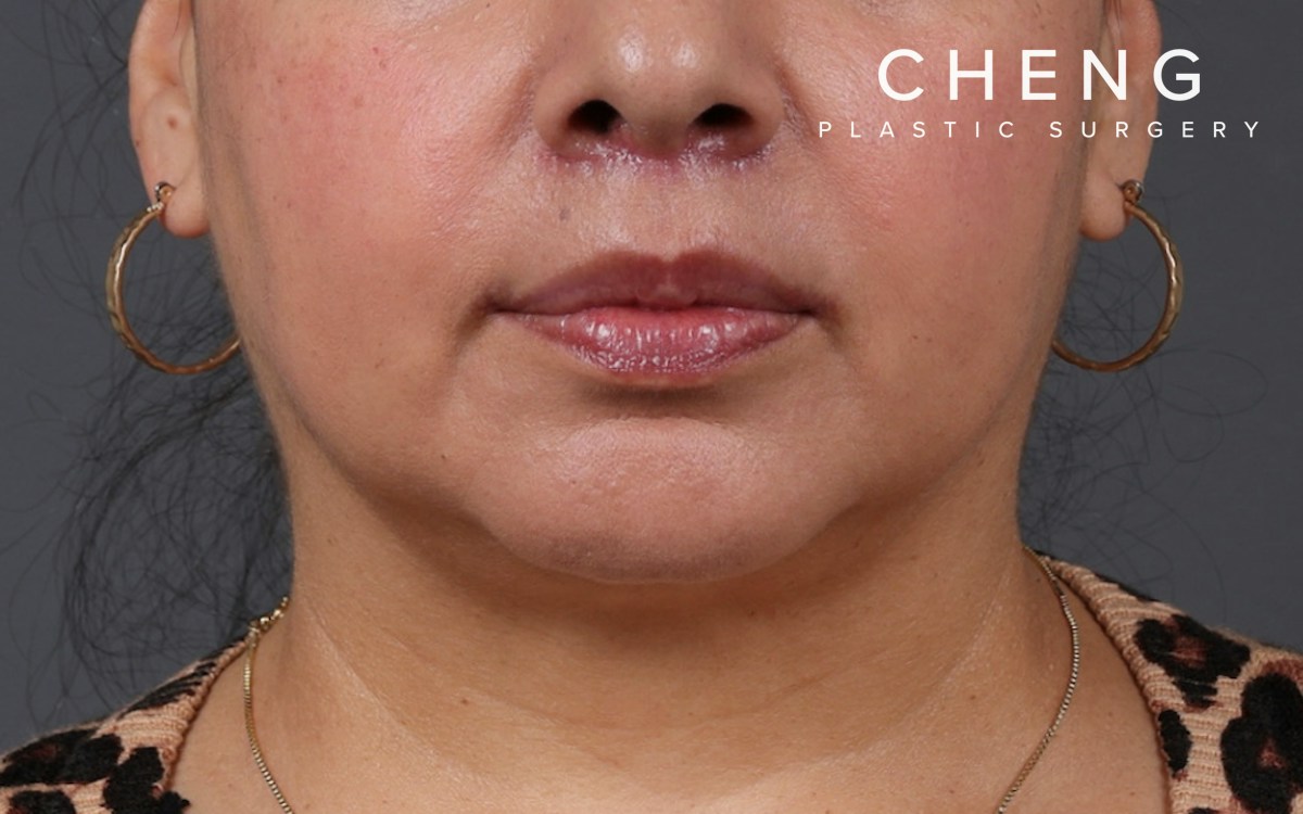 Lip Lift Before & After Gallery - Patient 209400 - Image 2