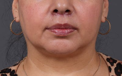 Lip Lift Before & After Gallery - Patient 209400 - Image 2