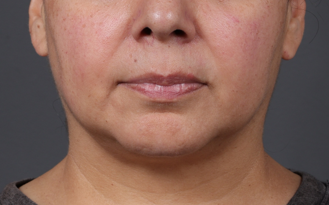 Lip Lift Before & After Gallery - Patient 209400 - Image 1
