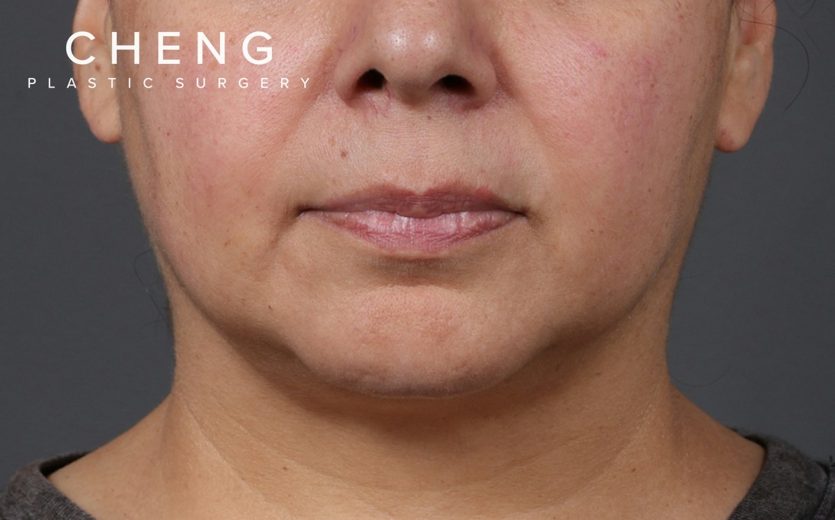 Lip Lift Before & After Gallery - Patient 209400 - Image 1