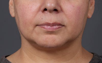 Lip Lift Before & After Gallery - Patient 209400 - Image 1