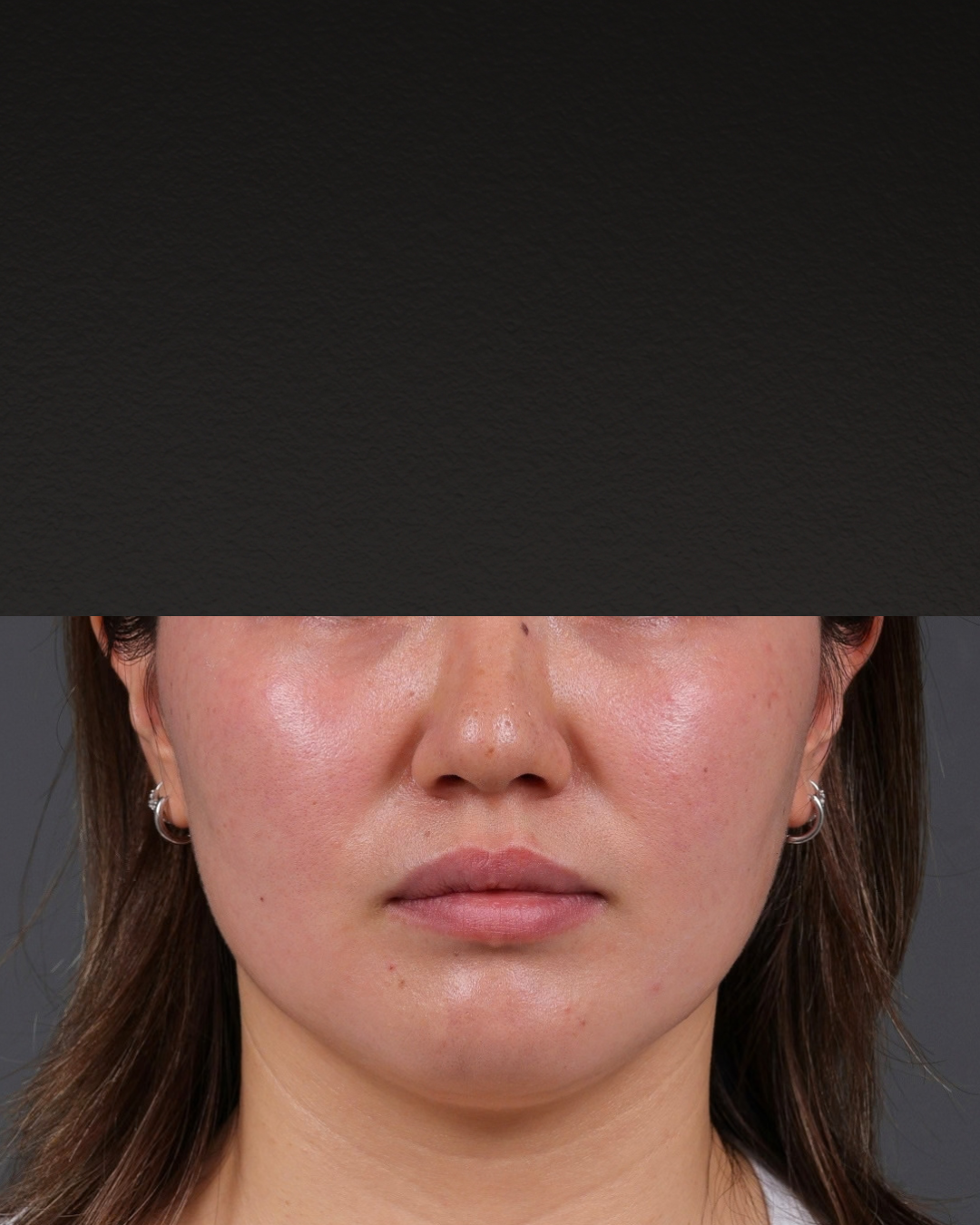 Botox and Dysport Before & After Gallery - Patient 295427 - Image 2
