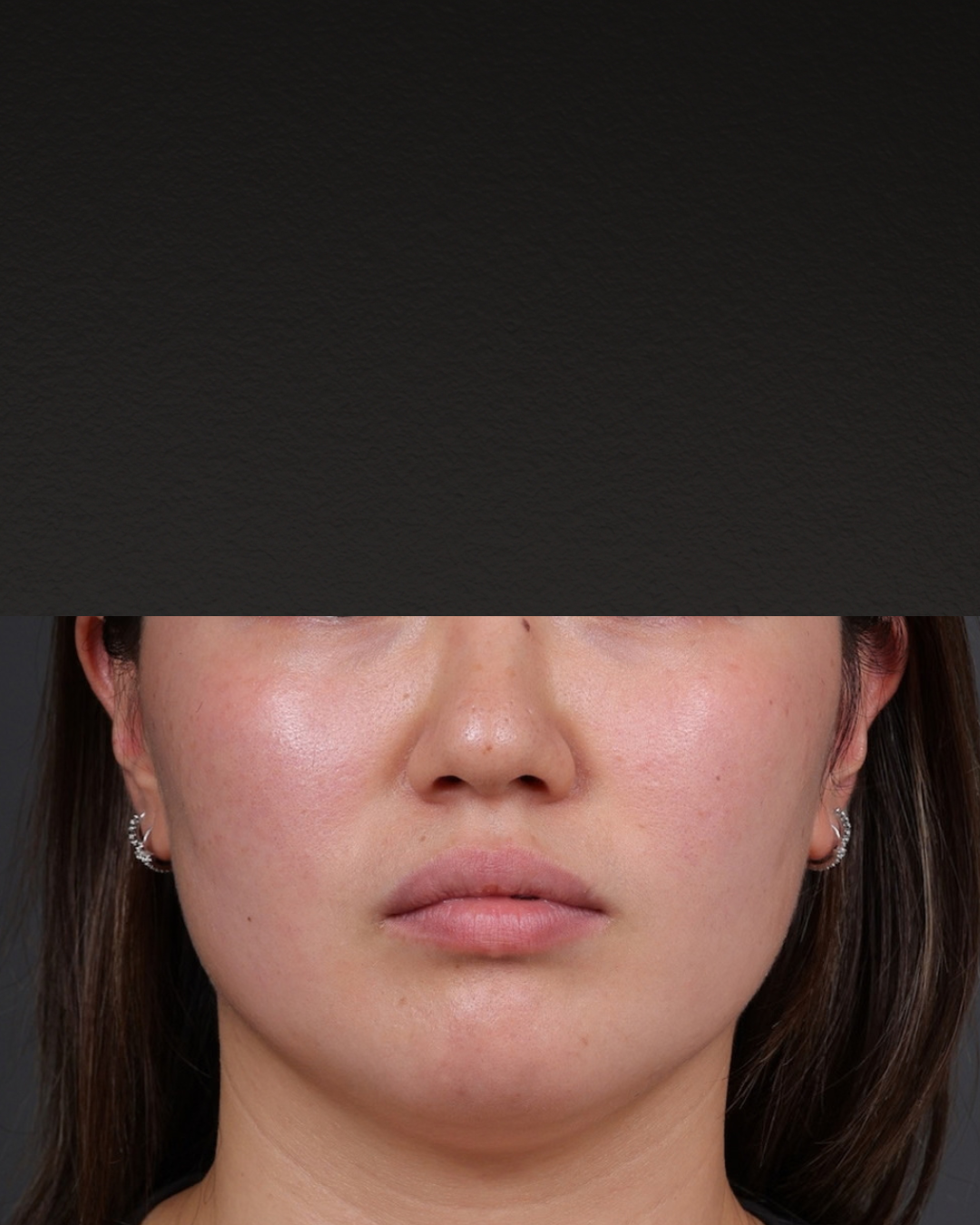 Botox and Dysport Before & After Gallery - Patient 295427 - Image 1