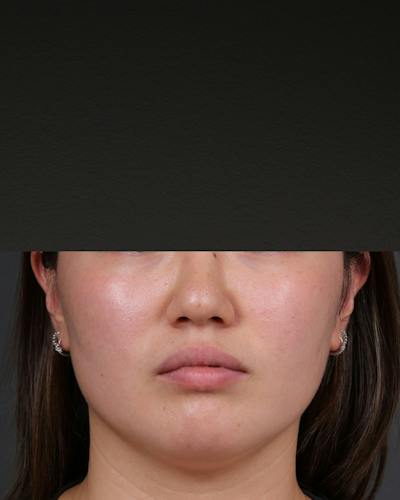 Botox and Dysport Before & After Gallery - Patient 295427 - Image 1