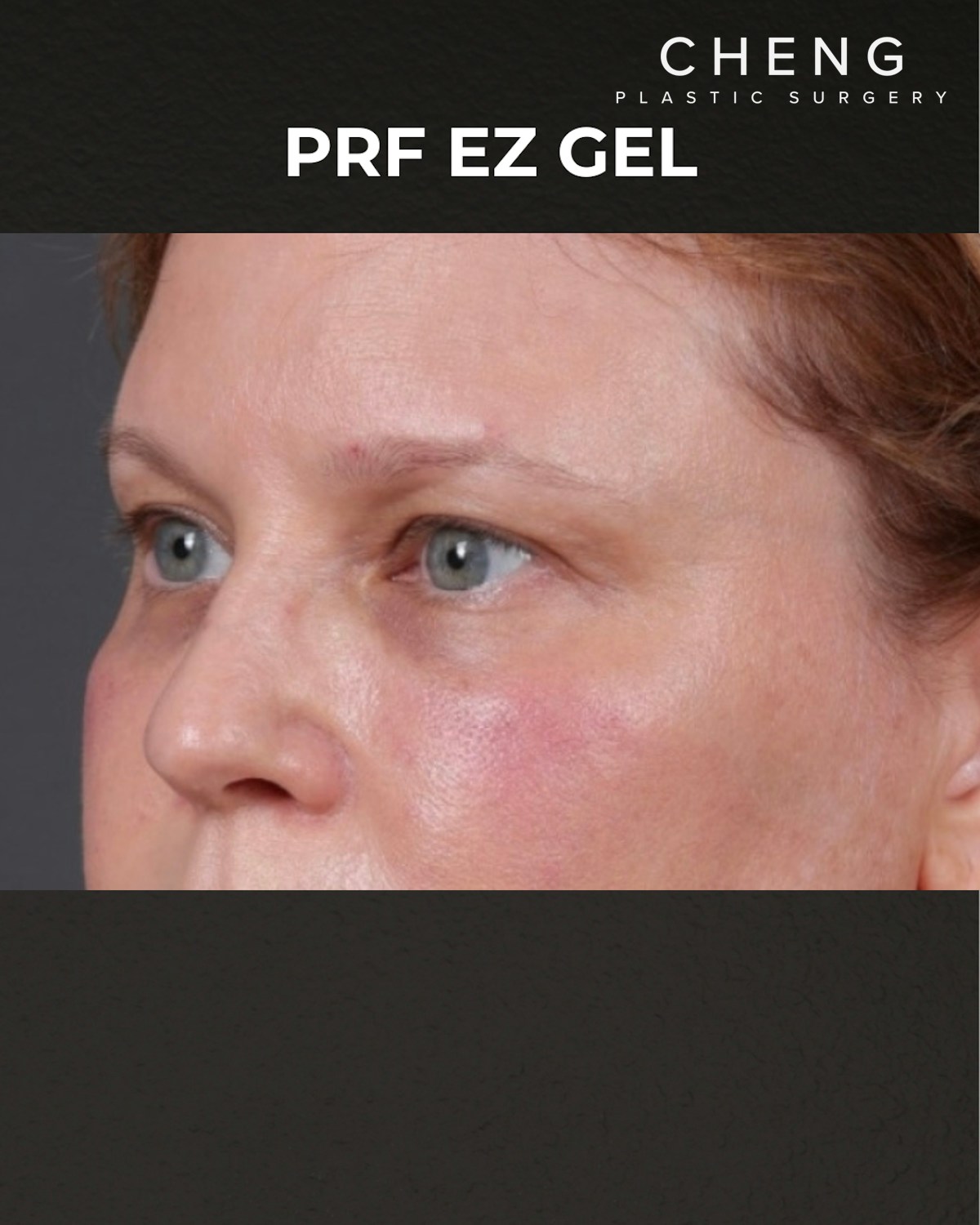 PRF Before & After Gallery - Patient 237270 - Image 4
