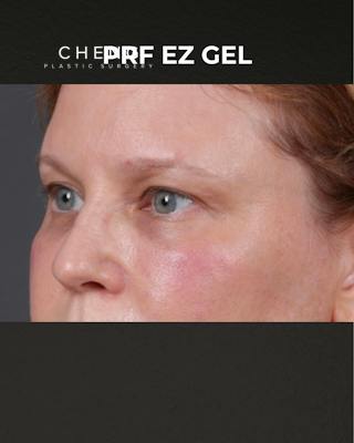 PRF Before & After Gallery - Patient 237270 - Image 4