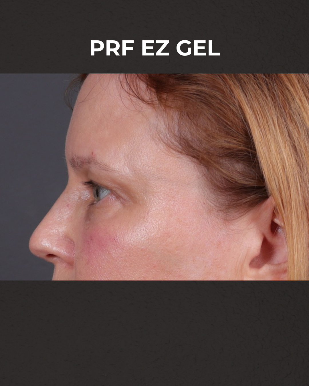 PRF Before & After Gallery - Patient 237270 - Image 6