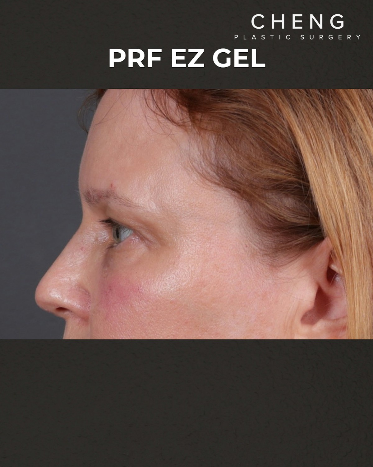 PRF Before & After Gallery - Patient 237270 - Image 6
