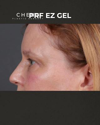PRF Before & After Gallery - Patient 237270 - Image 6