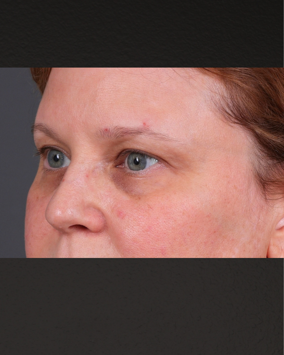 PRF Before & After Gallery - Patient 237270 - Image 3