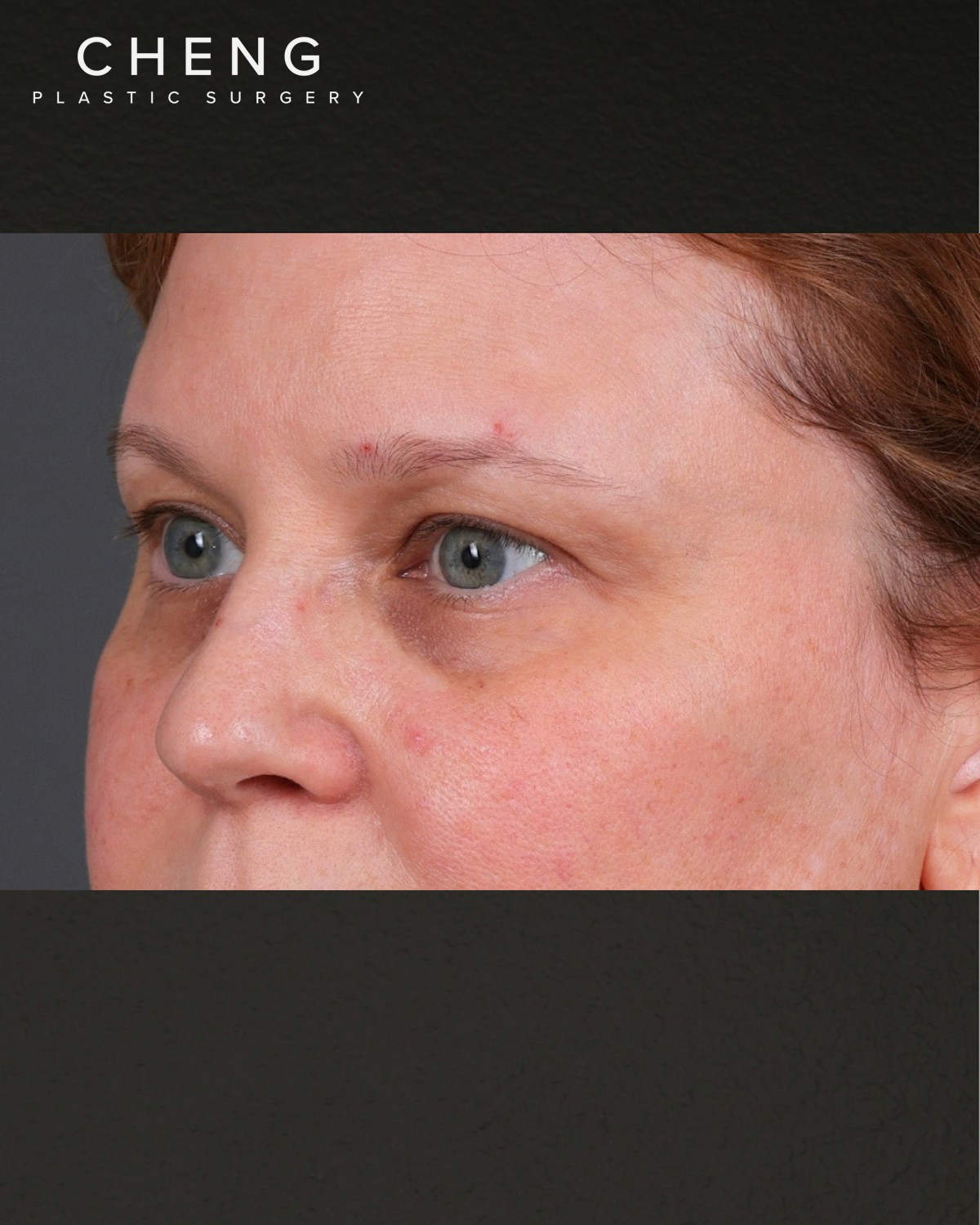 PRF Before & After Gallery - Patient 237270 - Image 3