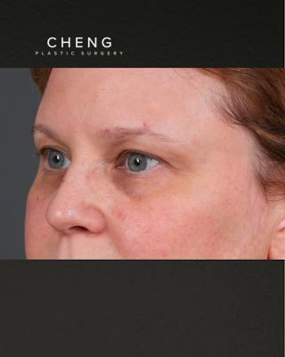 PRF Before & After Gallery - Patient 237270 - Image 3