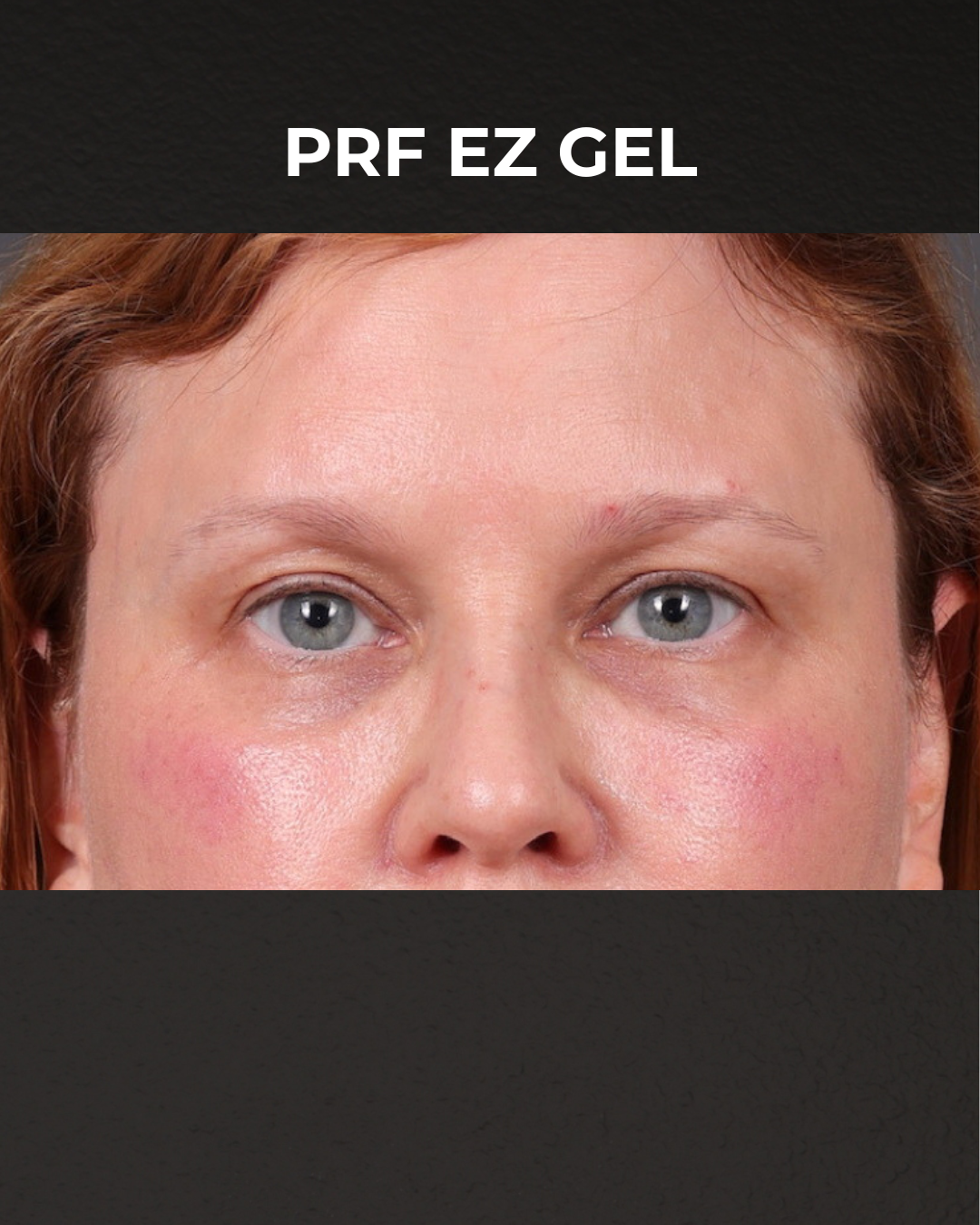 PRF Before & After Gallery - Patient 237270 - Image 2