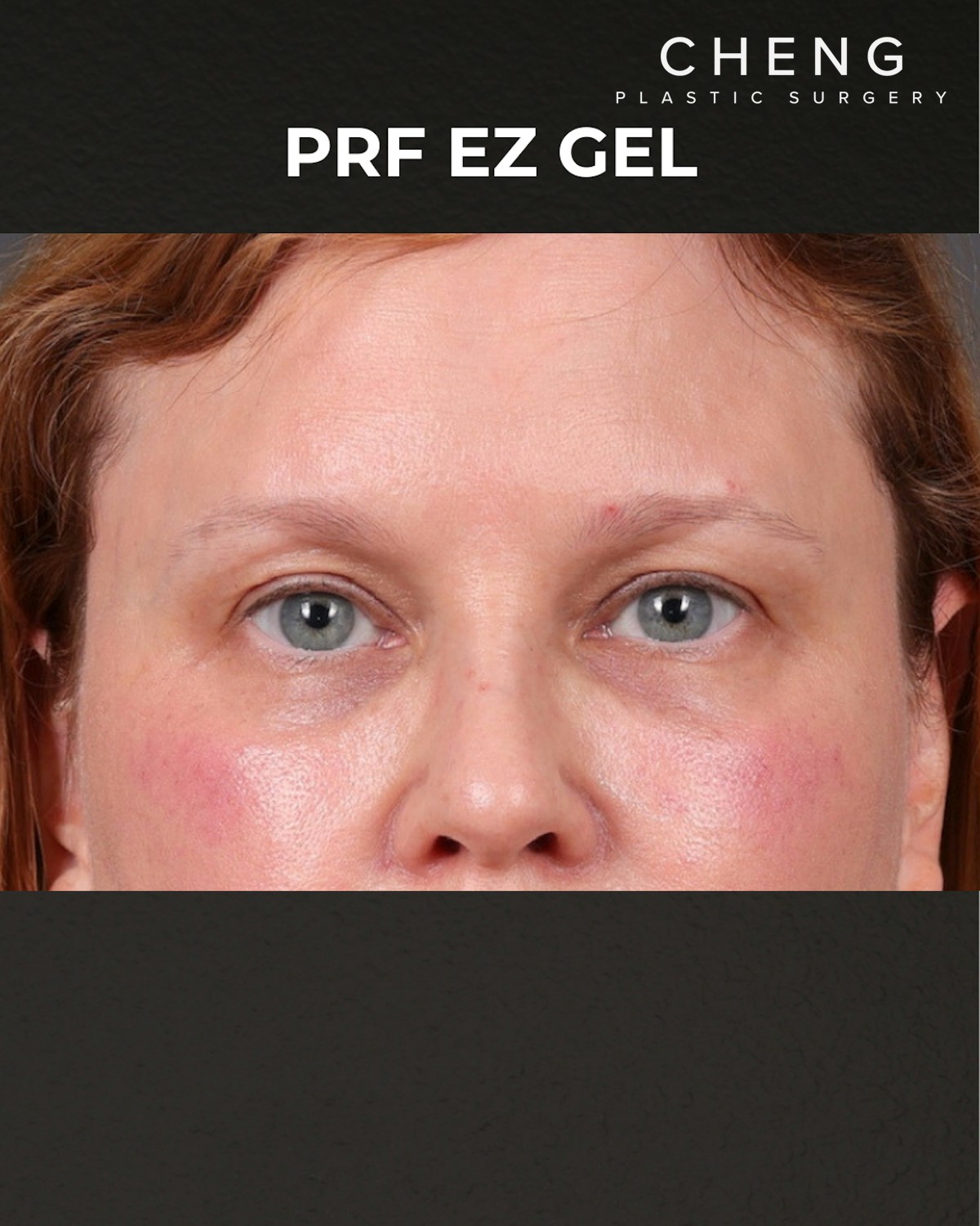 PRF Before & After Gallery - Patient 237270 - Image 2