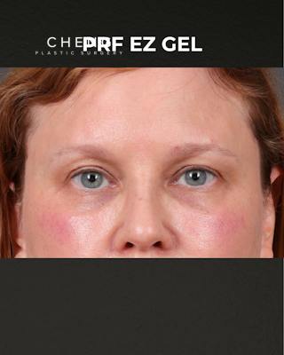 PRF Before & After Gallery - Patient 237270 - Image 2