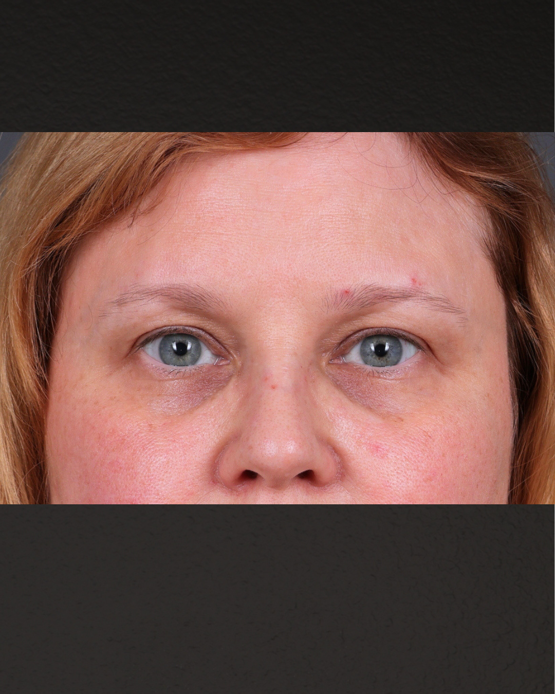 PRF Before & After Gallery - Patient 237270 - Image 1