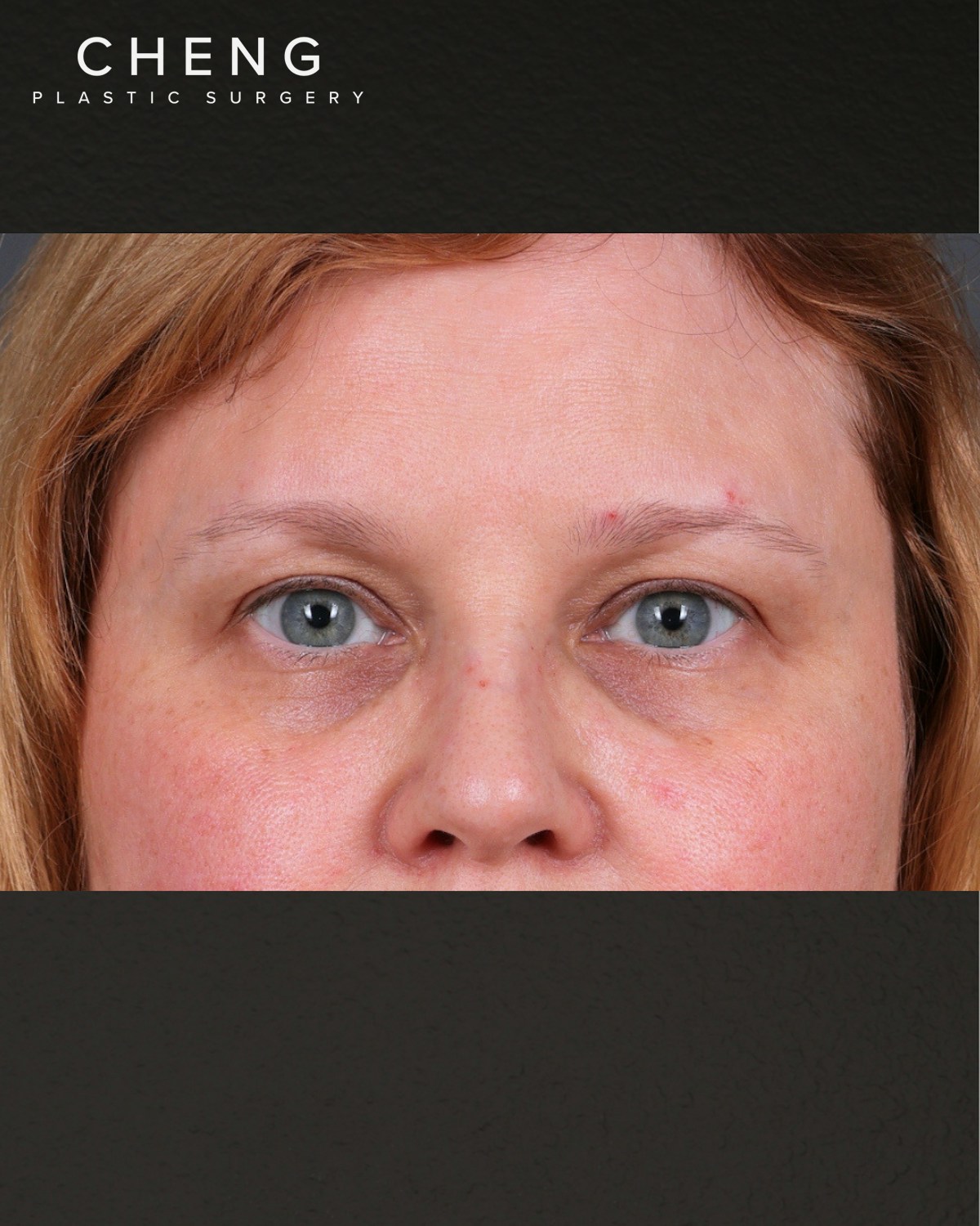 PRF Before & After Gallery - Patient 237270 - Image 1