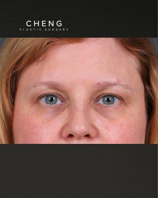 PRF Before & After Gallery - Patient 237270 - Image 1