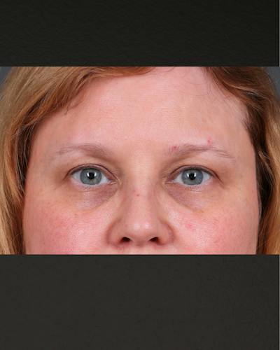 PRF Before & After Gallery - Patient 237270 - Image 1