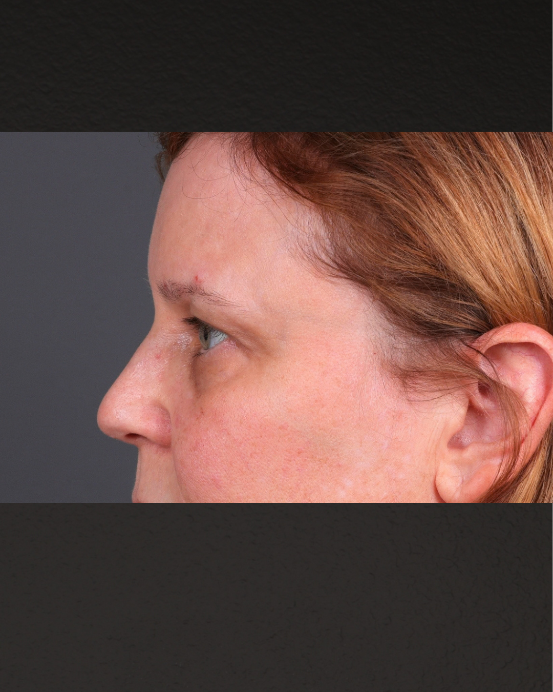 PRF Before & After Gallery - Patient 237270 - Image 5