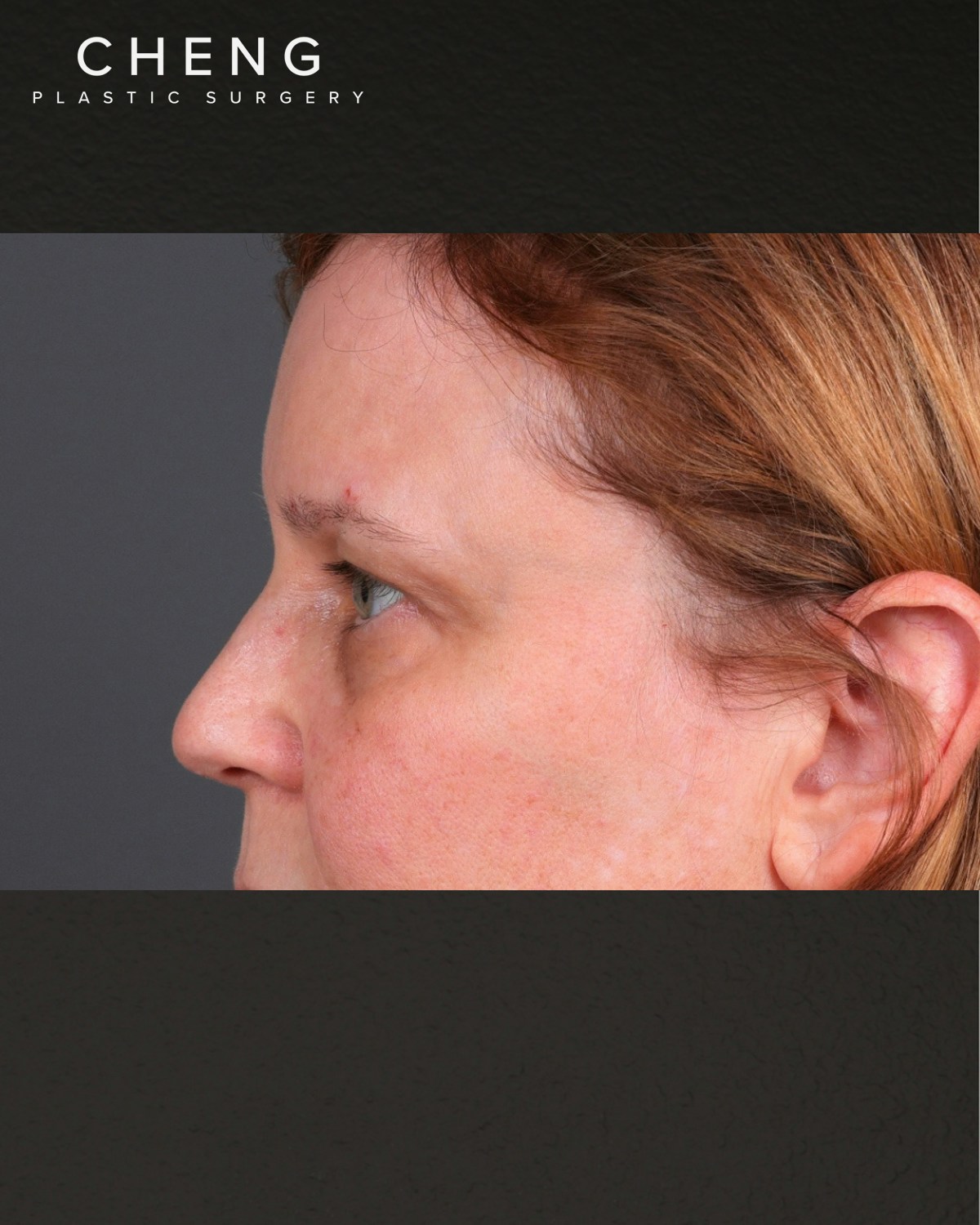 PRF Before & After Gallery - Patient 237270 - Image 5