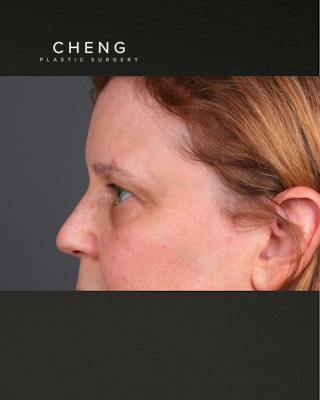 PRF Before & After Gallery - Patient 237270 - Image 5