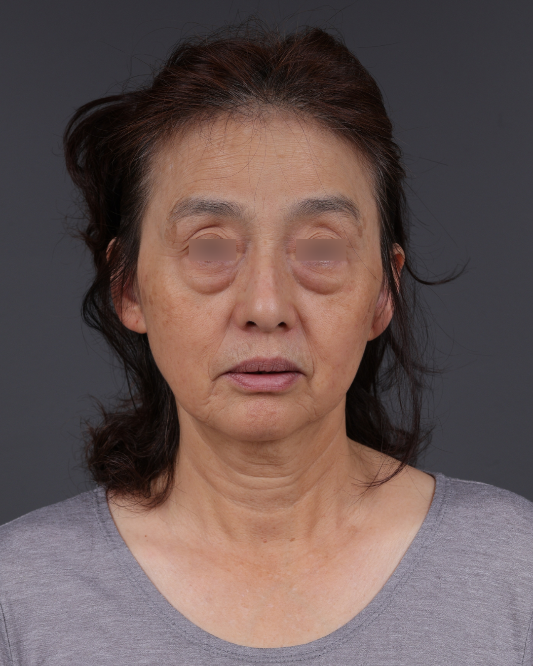 Blepharoplasty Before & After Gallery - Patient 189111 - Image 1