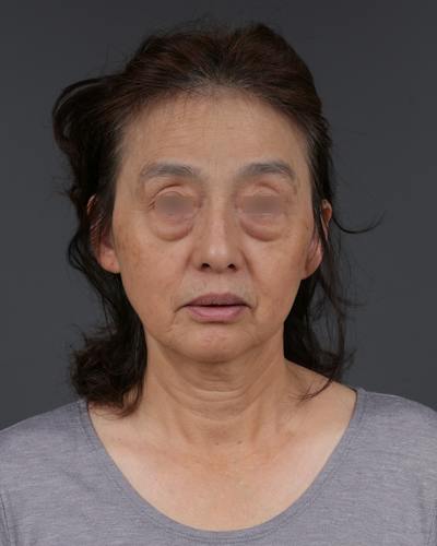 Blepharoplasty Before & After Gallery - Patient 189111 - Image 1