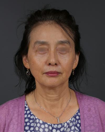 Blepharoplasty Before & After Gallery - Patient 189111 - Image 2