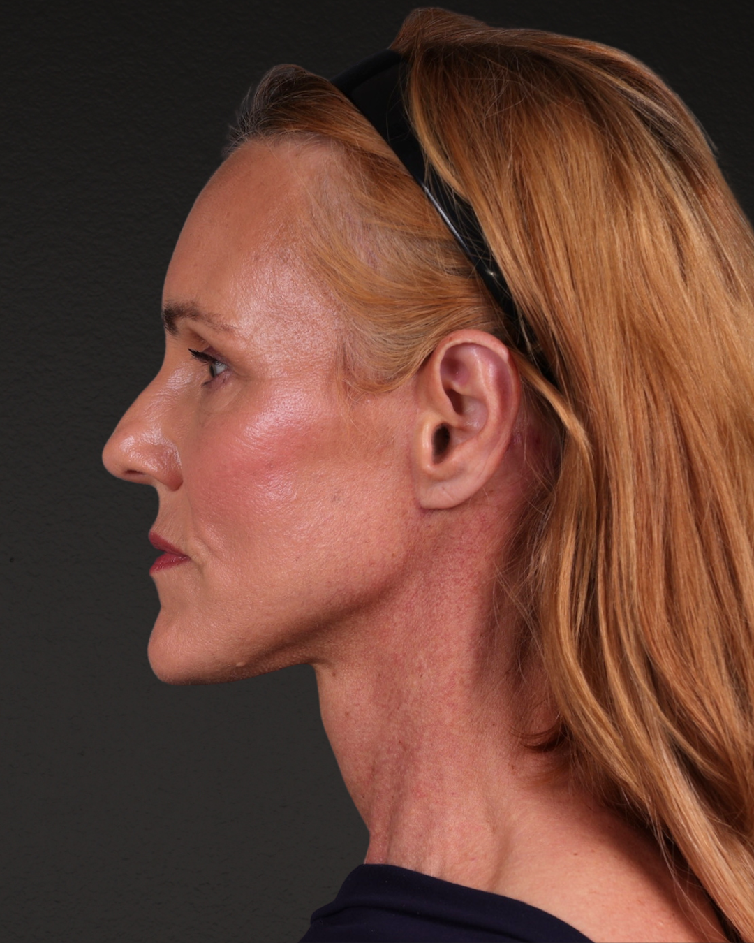 Facelift Before & After Gallery - Patient 298435 - Image 10